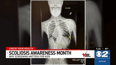 Image for story: Check Your Health- Scoliosis Awareness Month: Why Screening Matters for Kids 